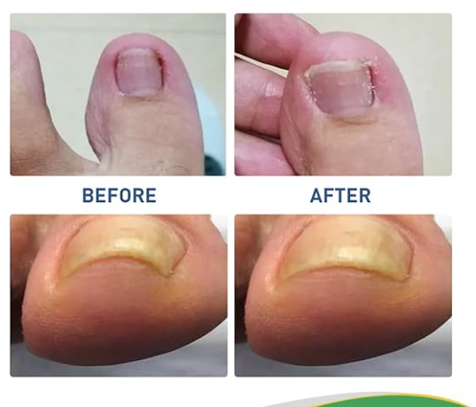 💅✨ Parches para Uñas Encarnadas – Protección y Cuidado para tus Pies 👣✅.