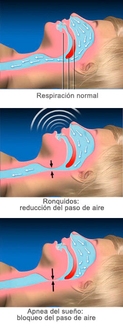 🛌✨ ¡Descubre el Secreto para Dormir Mejor y Despertar Renovado! 🌙💤 Placa Anti Bruxismo, Apnea y Ronquido 😴