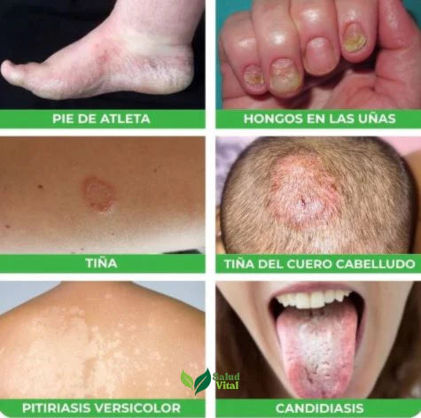 🌿 ADIÓS A LOS HONGOS, RECUPERA TUS UÑAS Y PIES, CON DERMAHONG ( 3 Unidades )🌿.