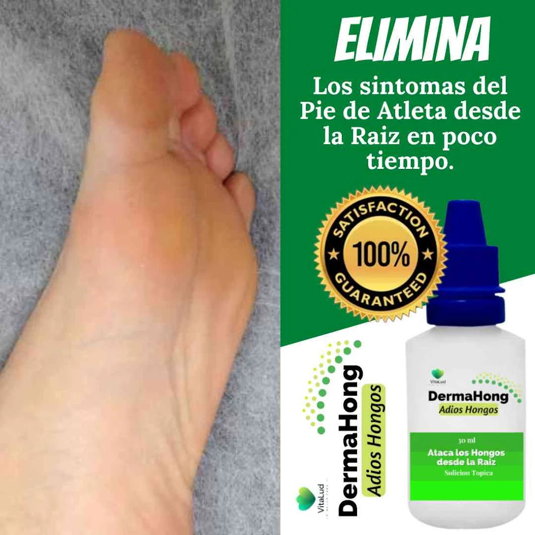 🌿 ADIÓS A LOS HONGOS, RECUPERA TUS UÑAS Y PIES, CON DERMAHONG ( 3 Unidades )🌿.